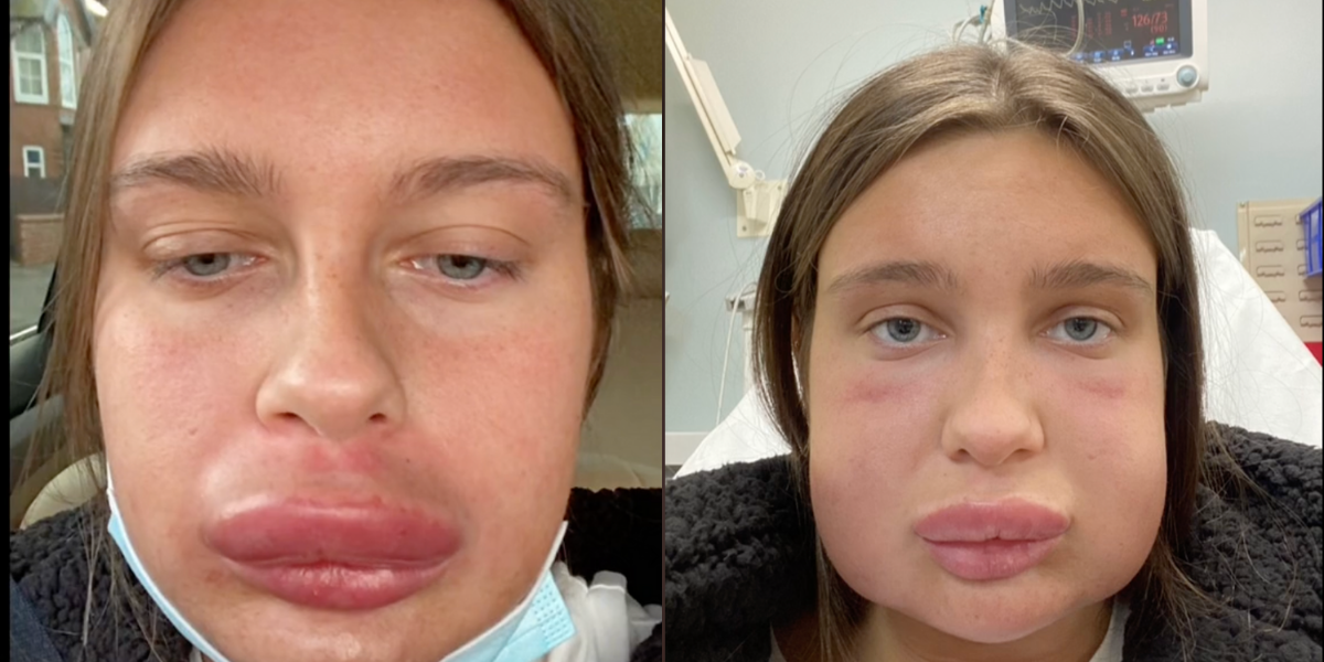 Woman's Lip FillerDissolving Treatment Causes Allergic Reaction VIDEO