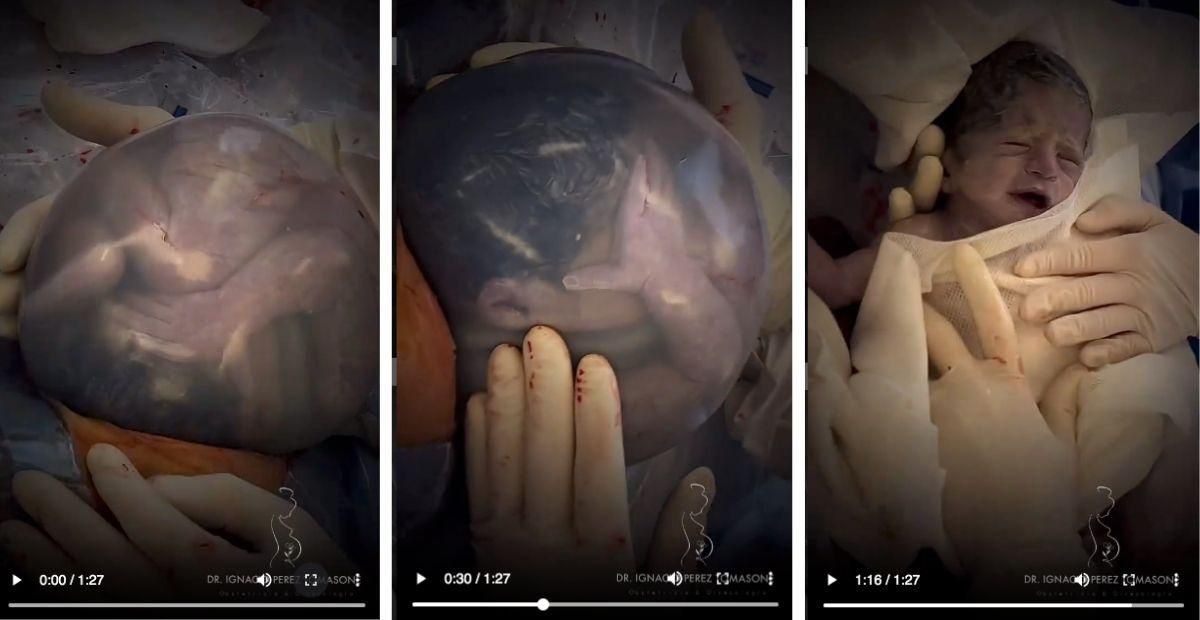 The strange case of the amniotic sac