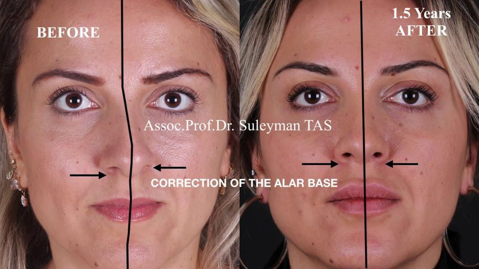 Nose Collapse After Rhinoplasty Nose Collapse After Rhinoplasty