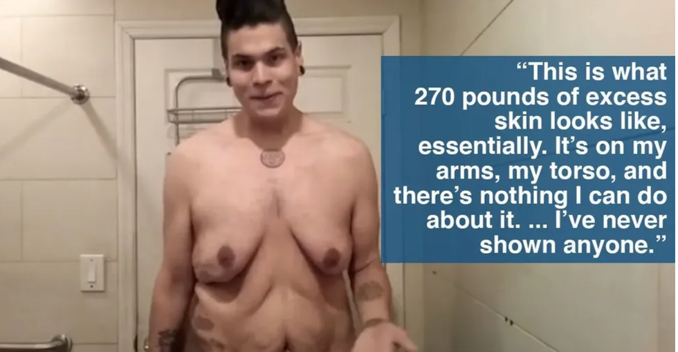 man shows excess skin post weight loss