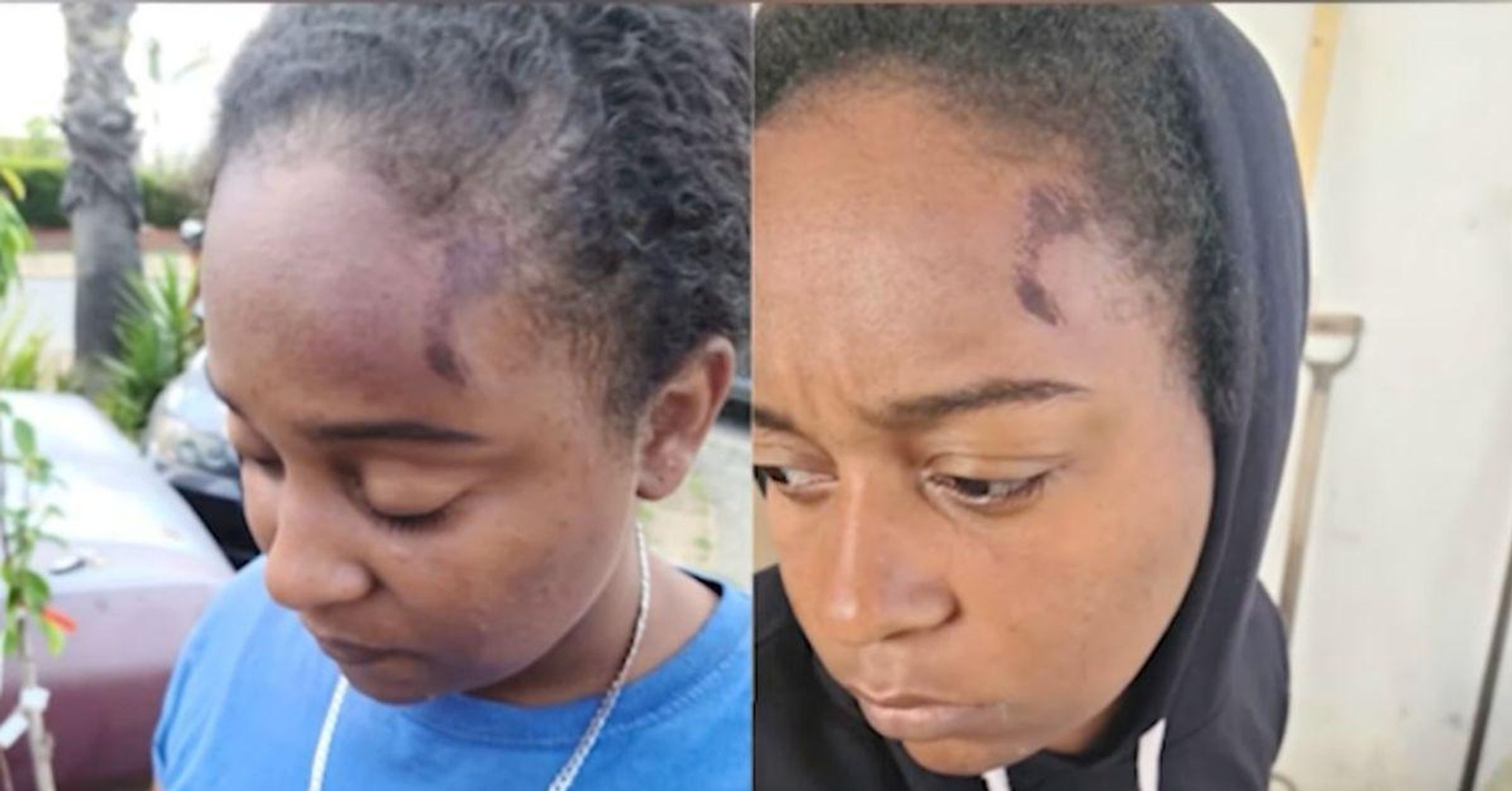 California Woman Sues After Cops Leave Her With Permanent Scars While She Filmed Arrest Happening In Her Yard