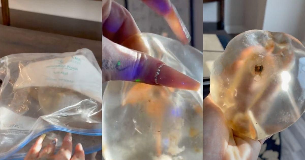 TikToker Who Got Her Breast Implants Removed Horrified To Realize They're Full Of Mold