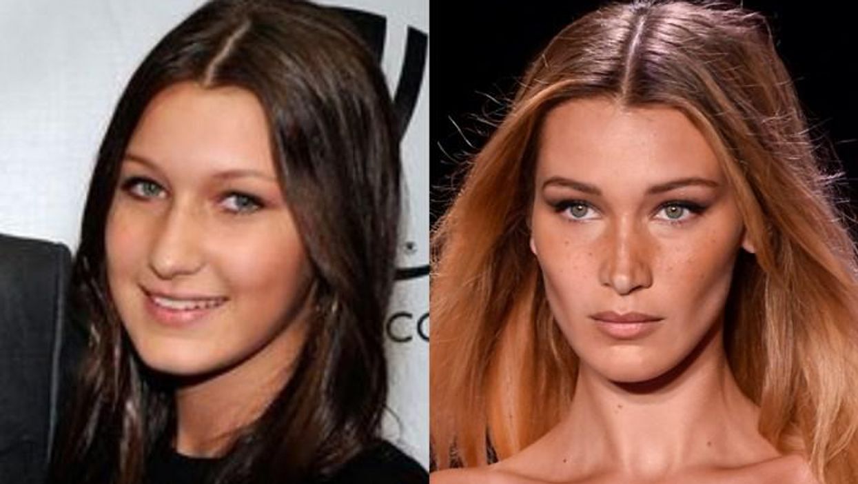 Before and After of Bella Hadid's Nose