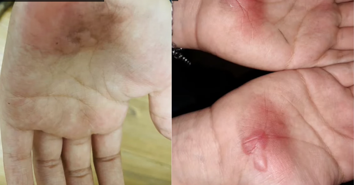Texas Middle Schoolers Suffer Severe Burns On Their Hands Due To Gym Teacher's Punishment