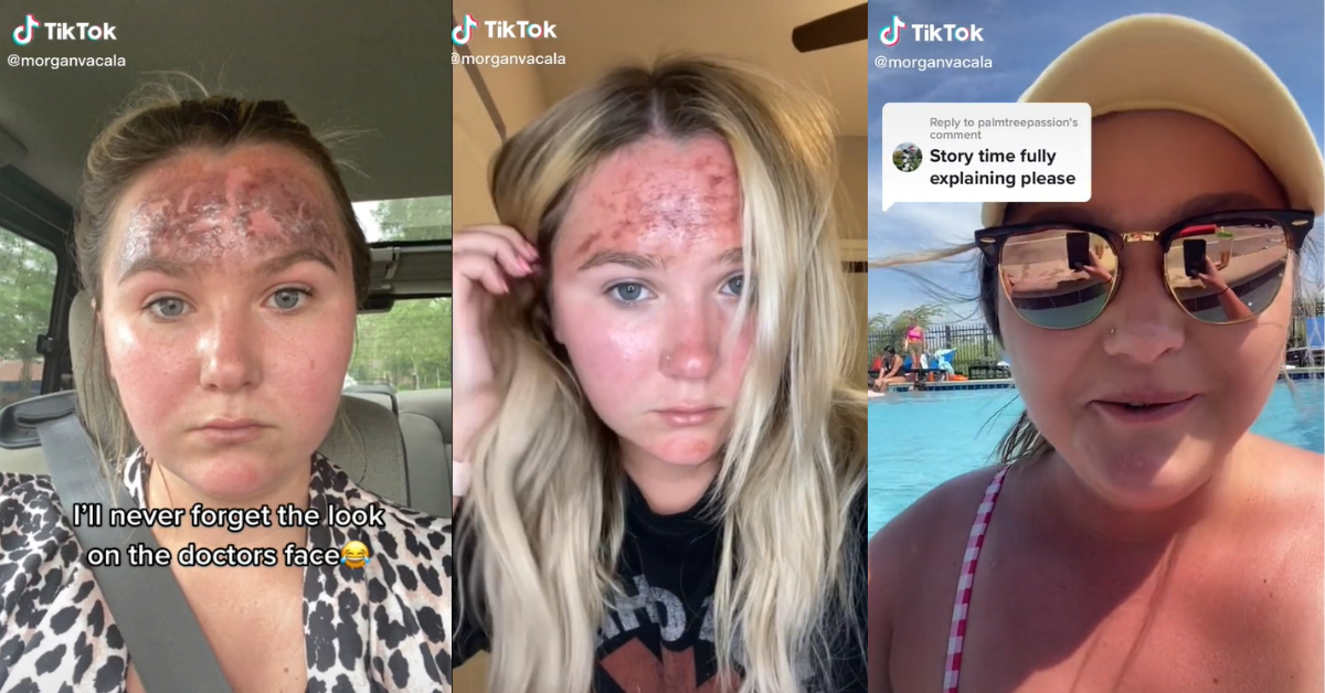 TikToker Warns Of The Dangers Of Using Expired Sunscreen After Suffering An Extreme Burn