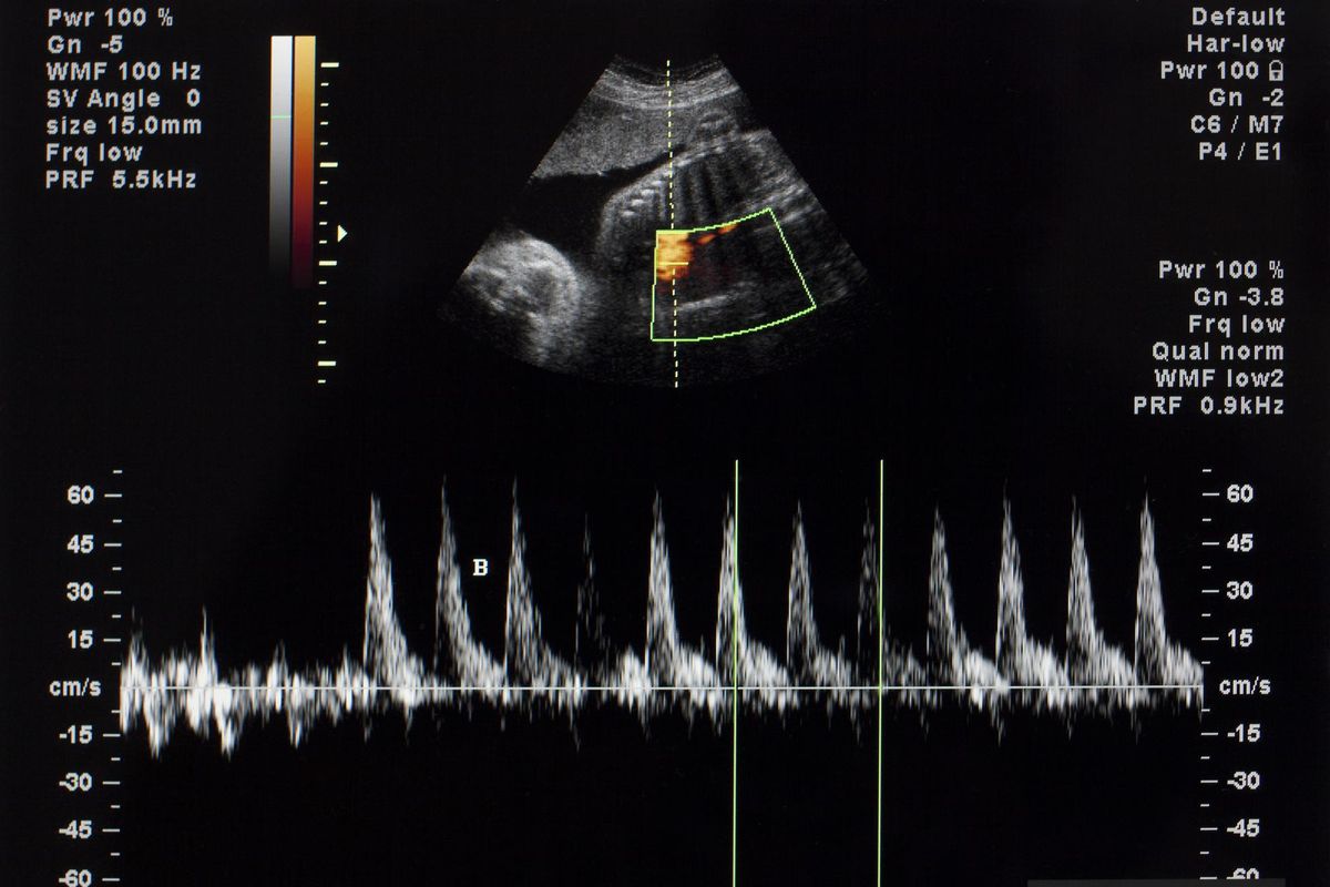 Il battito del bimbo prima dell’aborto? Consenso informato