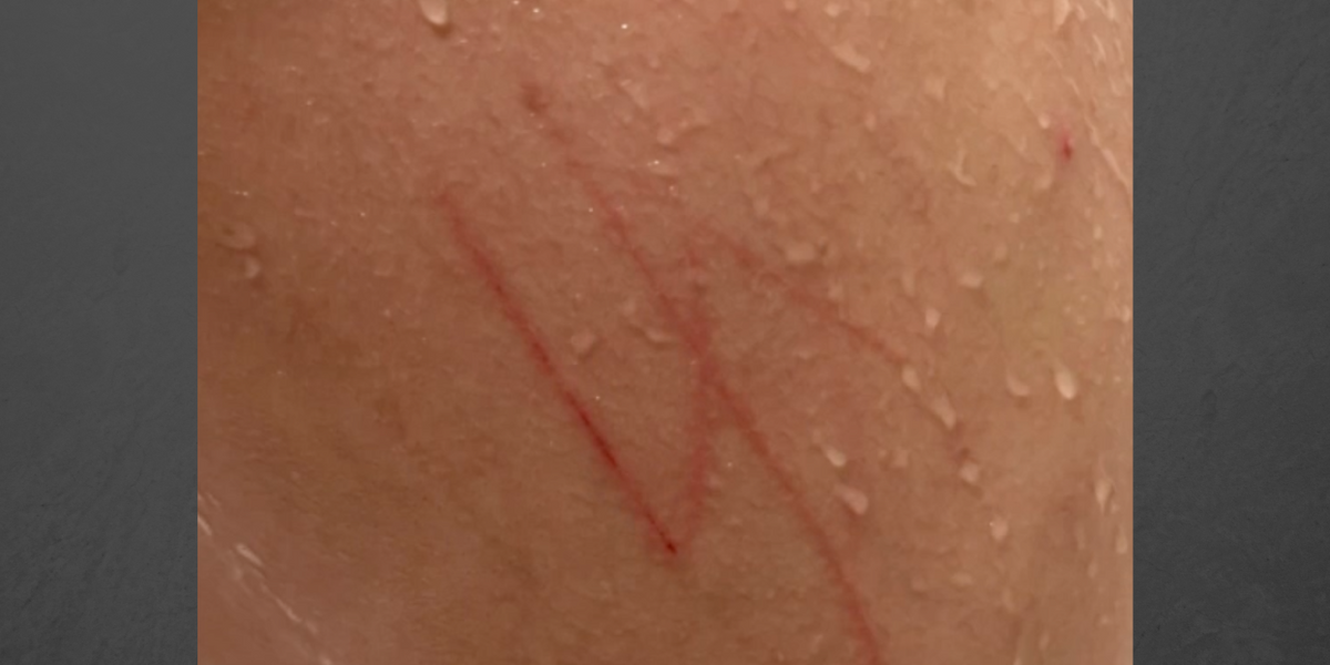 NextImg:Jewish boy with autism returned from school with swastika carved into his skin, mother says; FBI 'prepared to investigate'