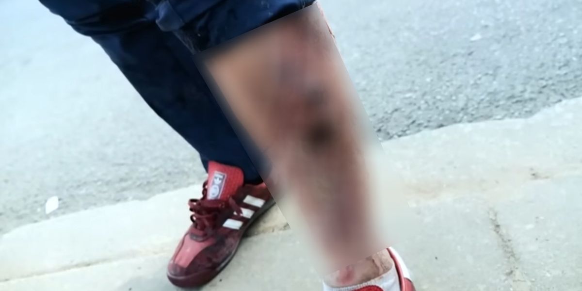 NextImg:Veterinary drug transforming American city streets into zombie nightmares: 'Literally eats your flesh'