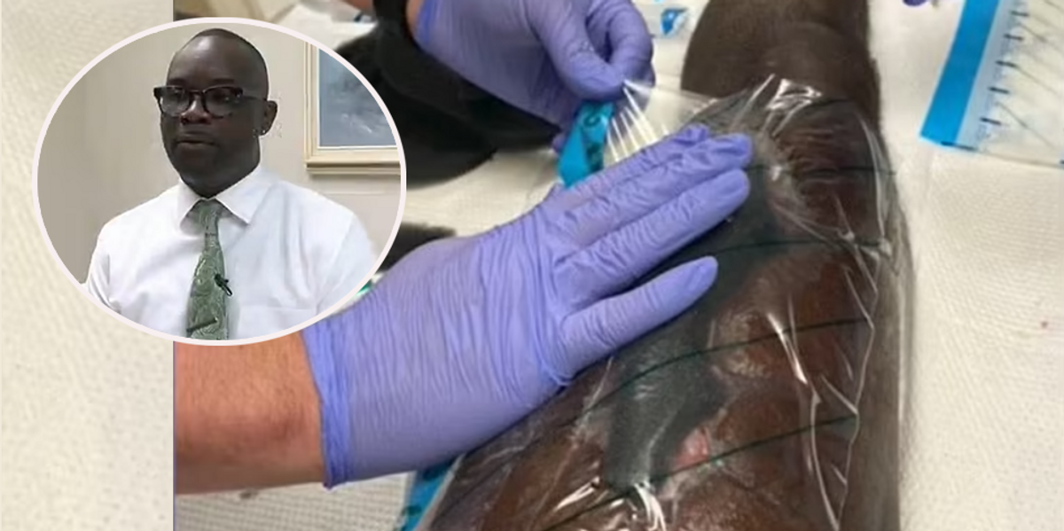 NextImg:Man gets flesh-eating bacteria after he's bitten by family member during fight at family function