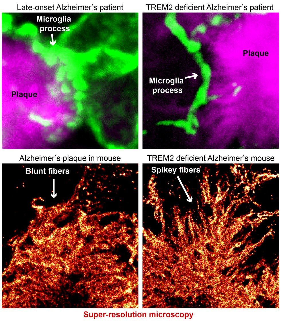 The Immune Cells: A Possible Solution To The Fight Against Alzheimer's