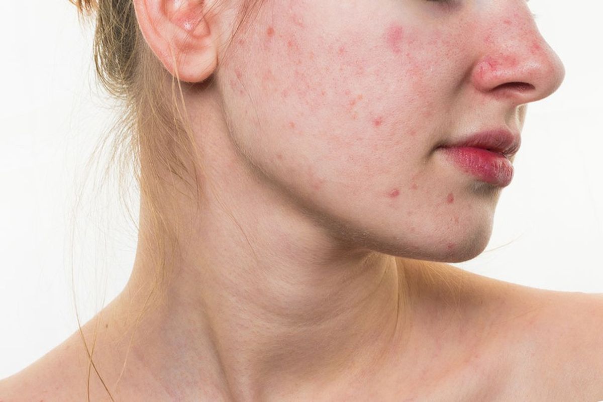Acne: It Changed Me
