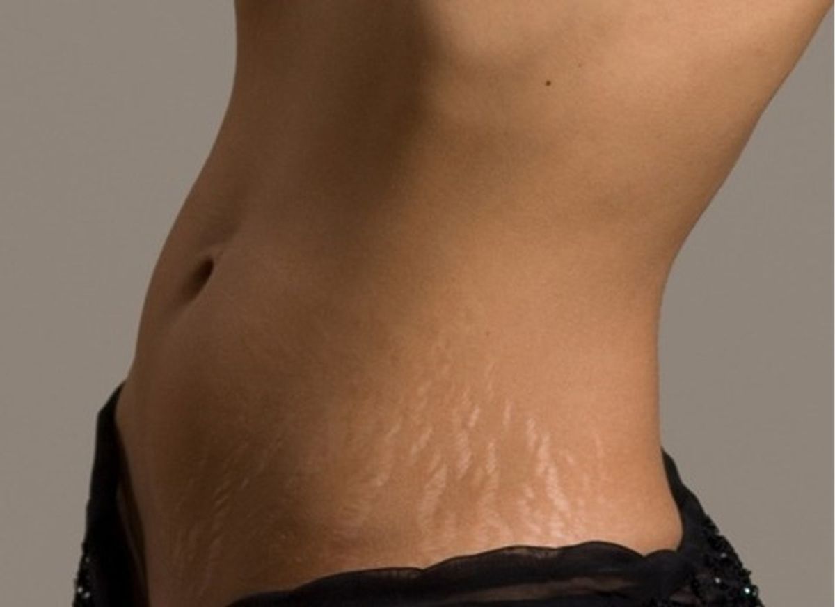 Why Stretch Marks are Okay
